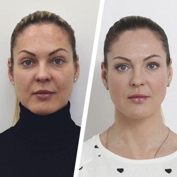 Antes e despois de rexuvenecemento da pel facial sen cirurxía