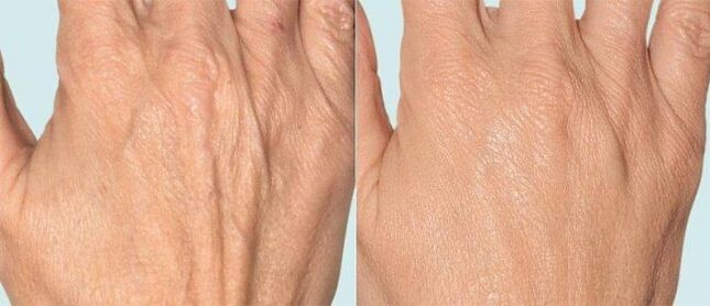 Pel das mans antes e despois da terapia fraccionada