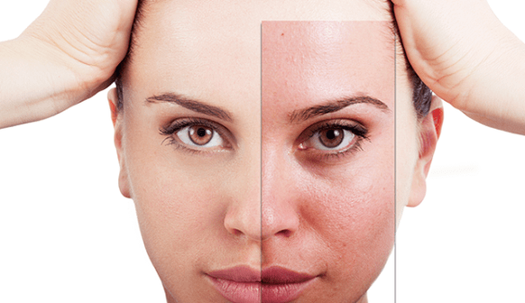 o rexuvenecemento fraccionado elimina os principais defectos estéticos da cara