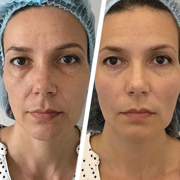 foto facial antes e despois do rexuvenecemento con láser